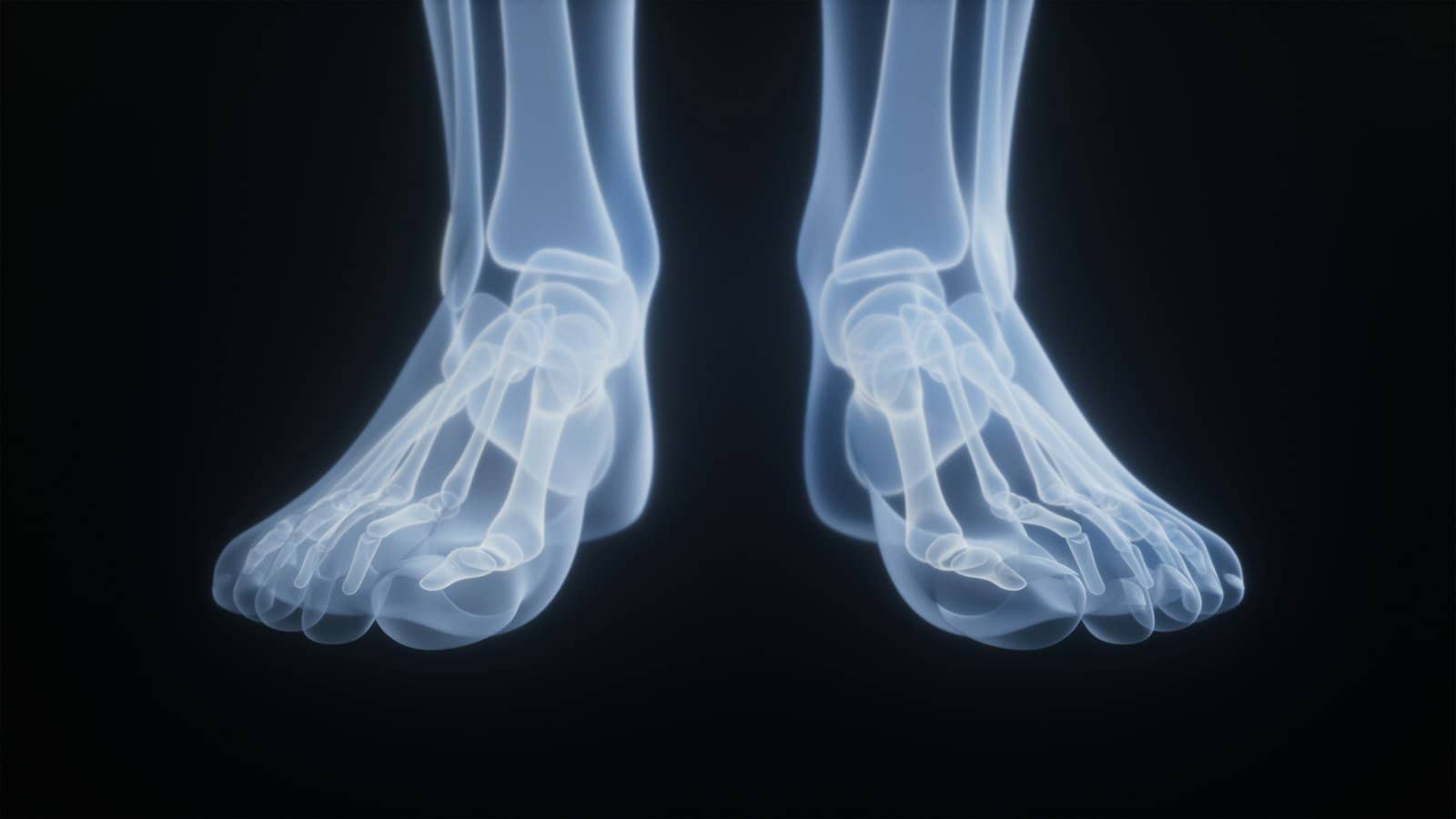 Osteoporose: sintomas, exames e tratamento