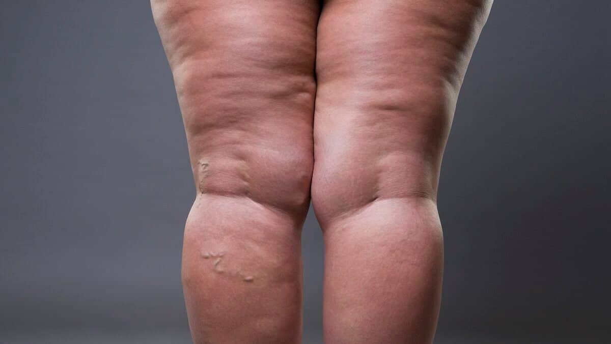 Qual médico trata lipedema? Especialistas e quando procurar