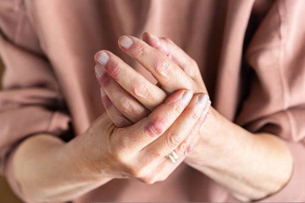 Psoríase e estresse: por que a pele piora e como controlar