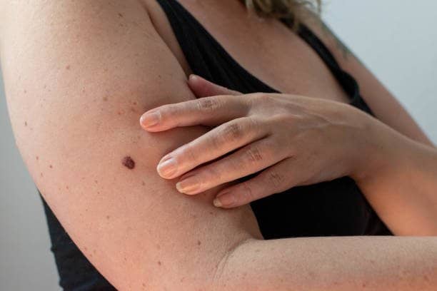 Pinta ou câncer de pele? Regra ABCDE e sinais de alerta