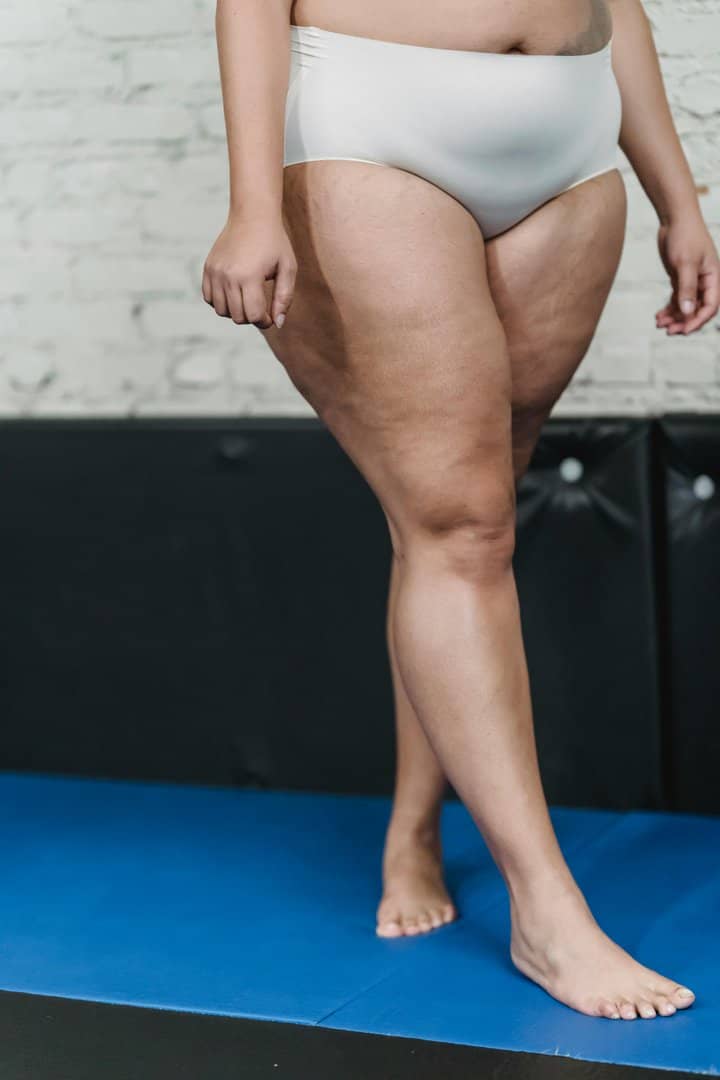 Lipedema: o que é, sintomas e como diferenciar de obesidade